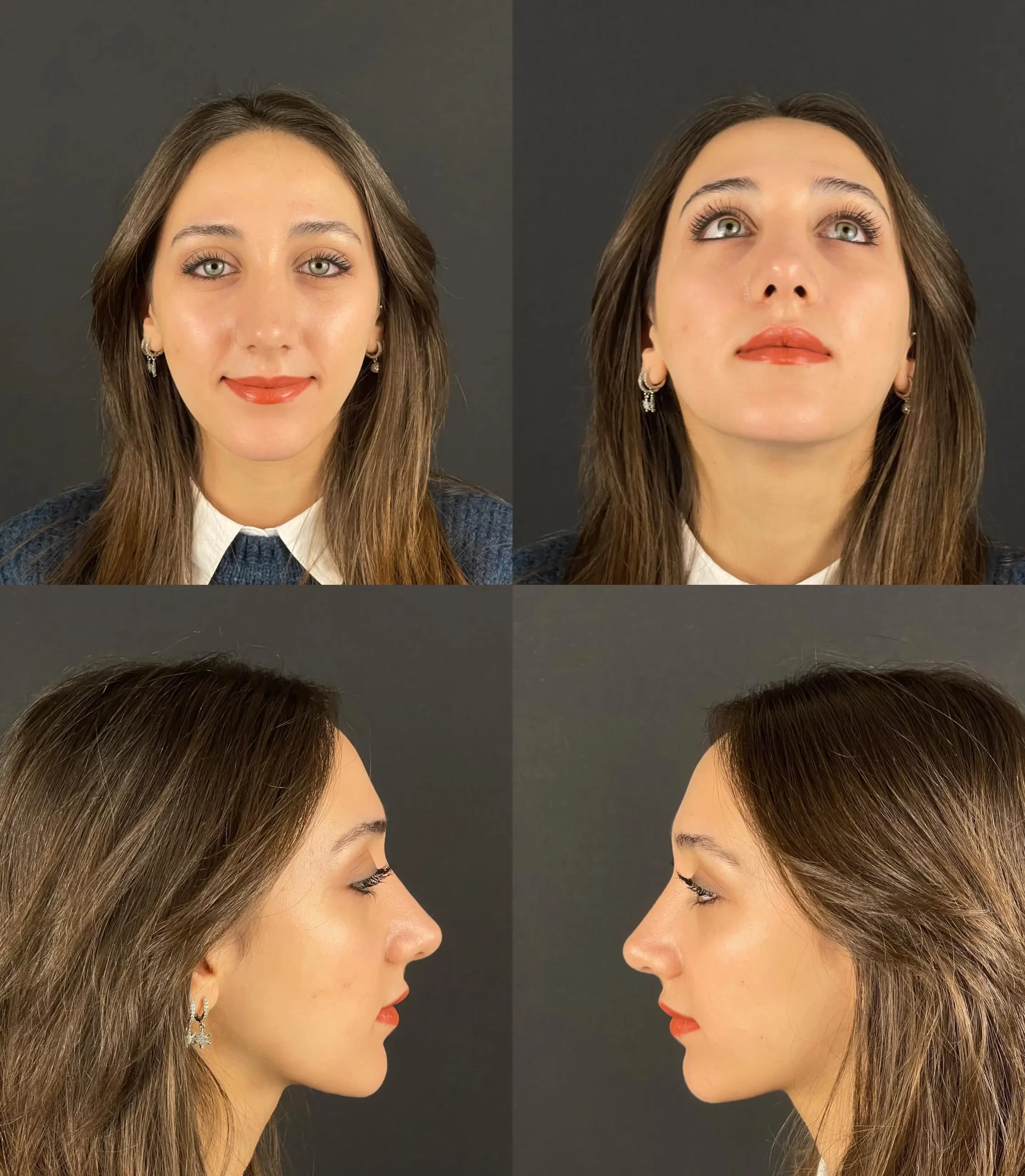 Rhinoplasty patient showing balanced and symmetrical results from front, side, and upward views, highlighting elegant enhancements.