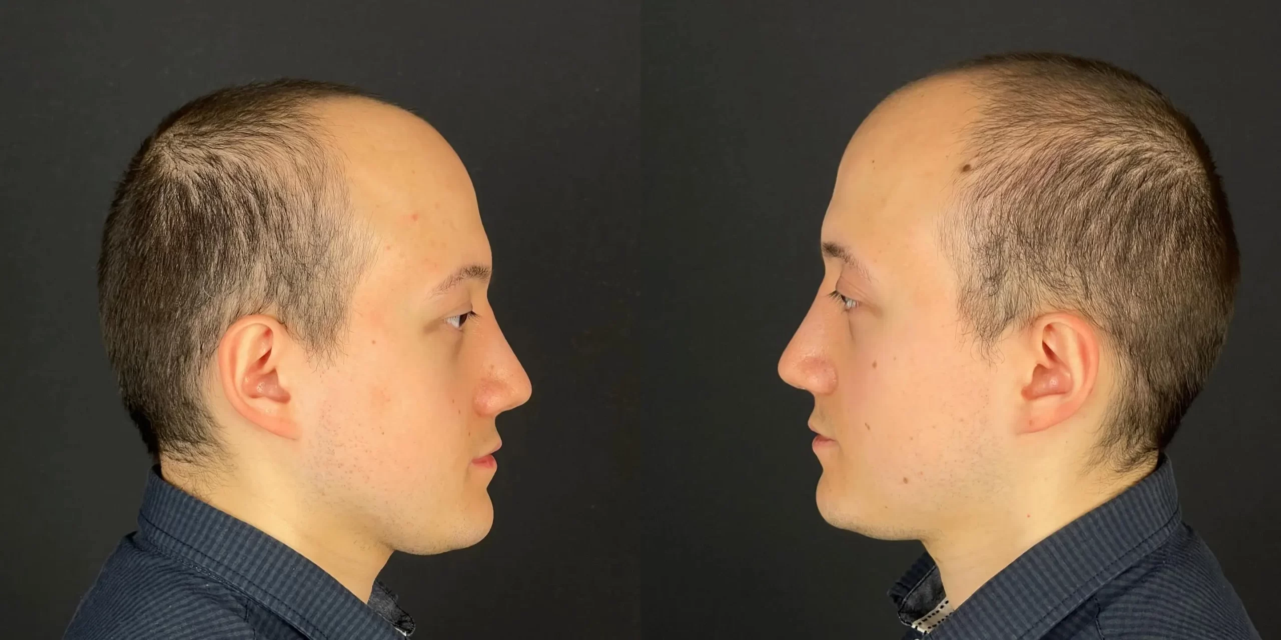 Rhinoplasty patient showing before and after profile views, emphasizing balanced and natural results.