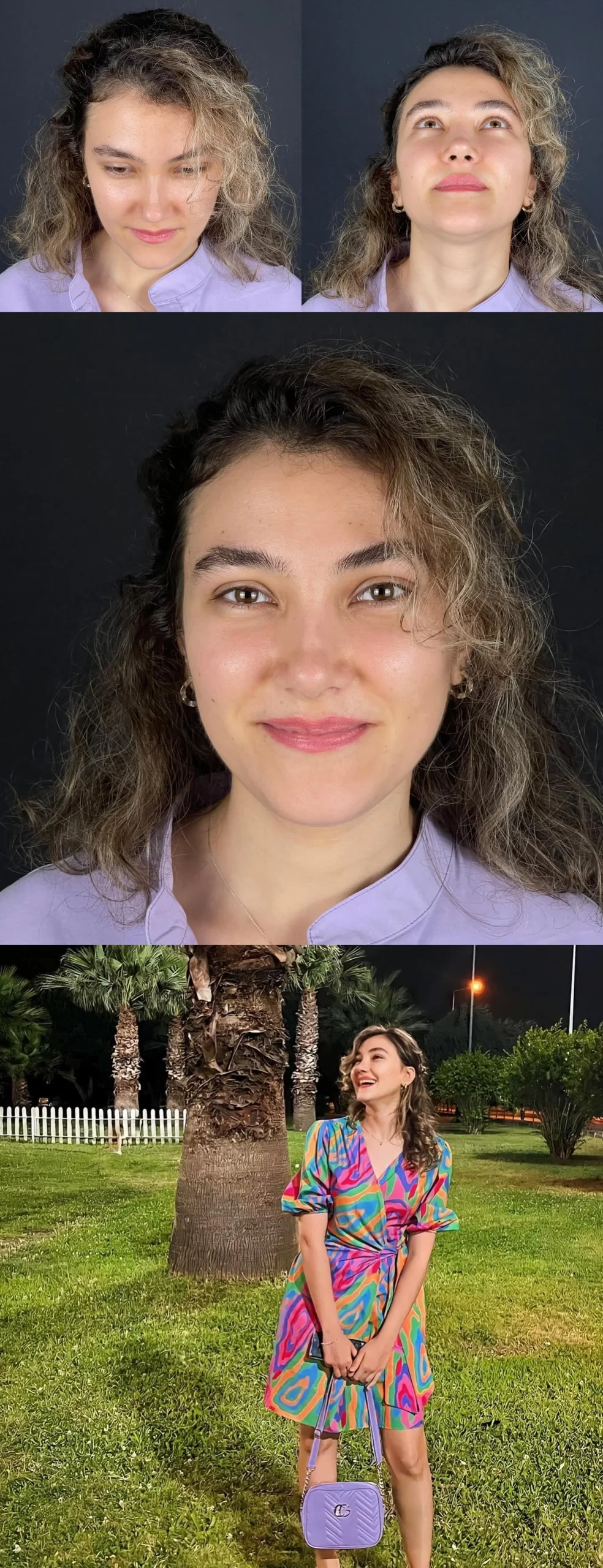 Post-rhinoplasty patient showing clinical angles and a lifestyle image, highlighting balanced results and confidence.