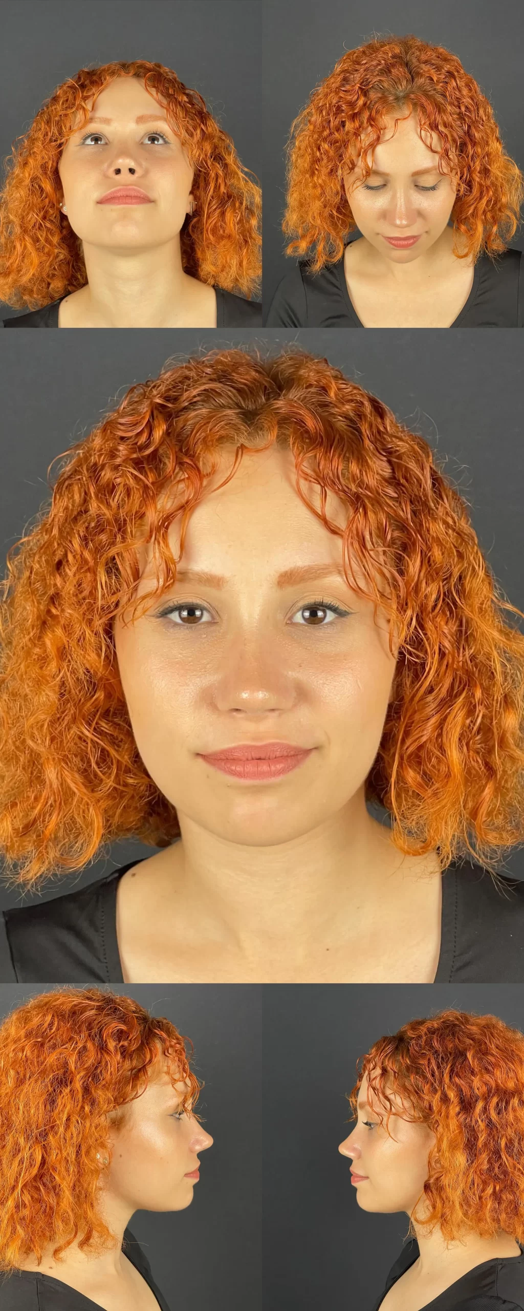Post-rhinoplasty patient with vibrant curly hair, showing different angles, including front, side, and under-view perspectives.