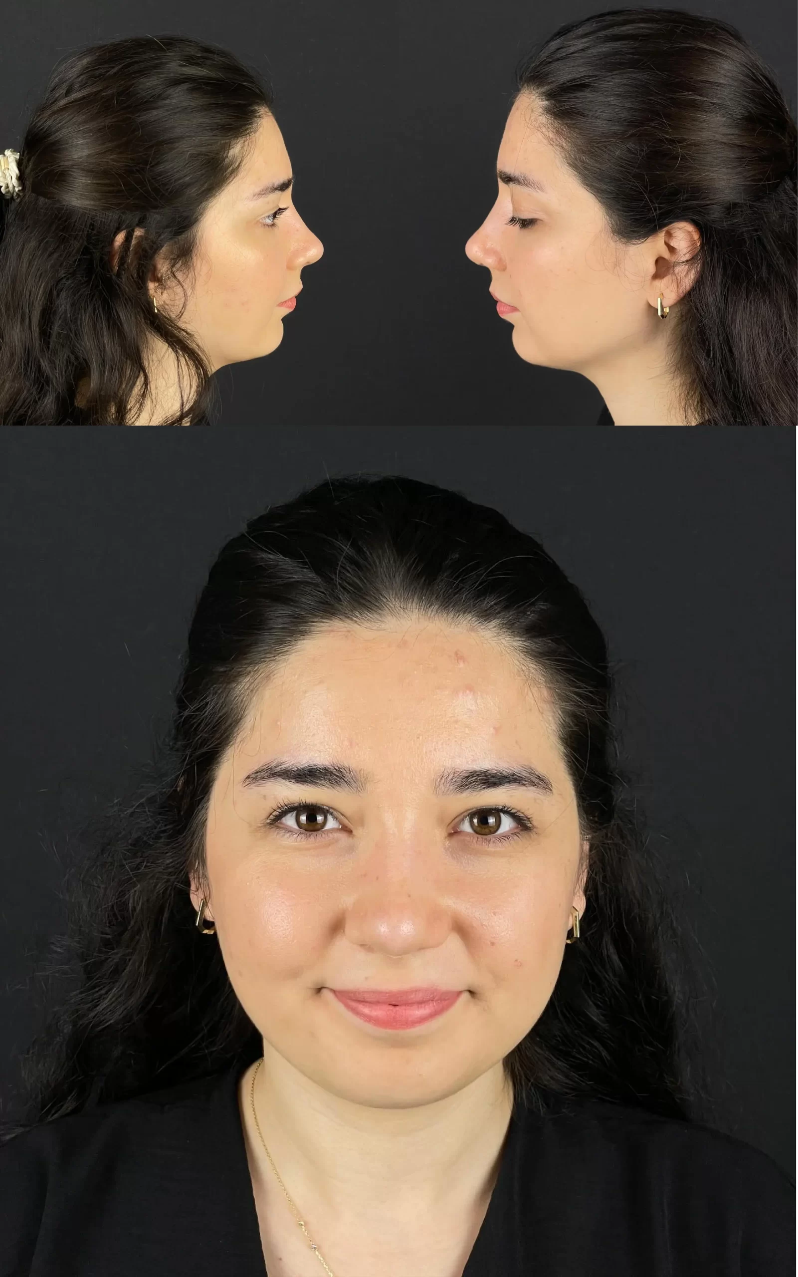 Post-rhinoplasty patient showing profile and frontal views, emphasizing natural symmetry and balance.