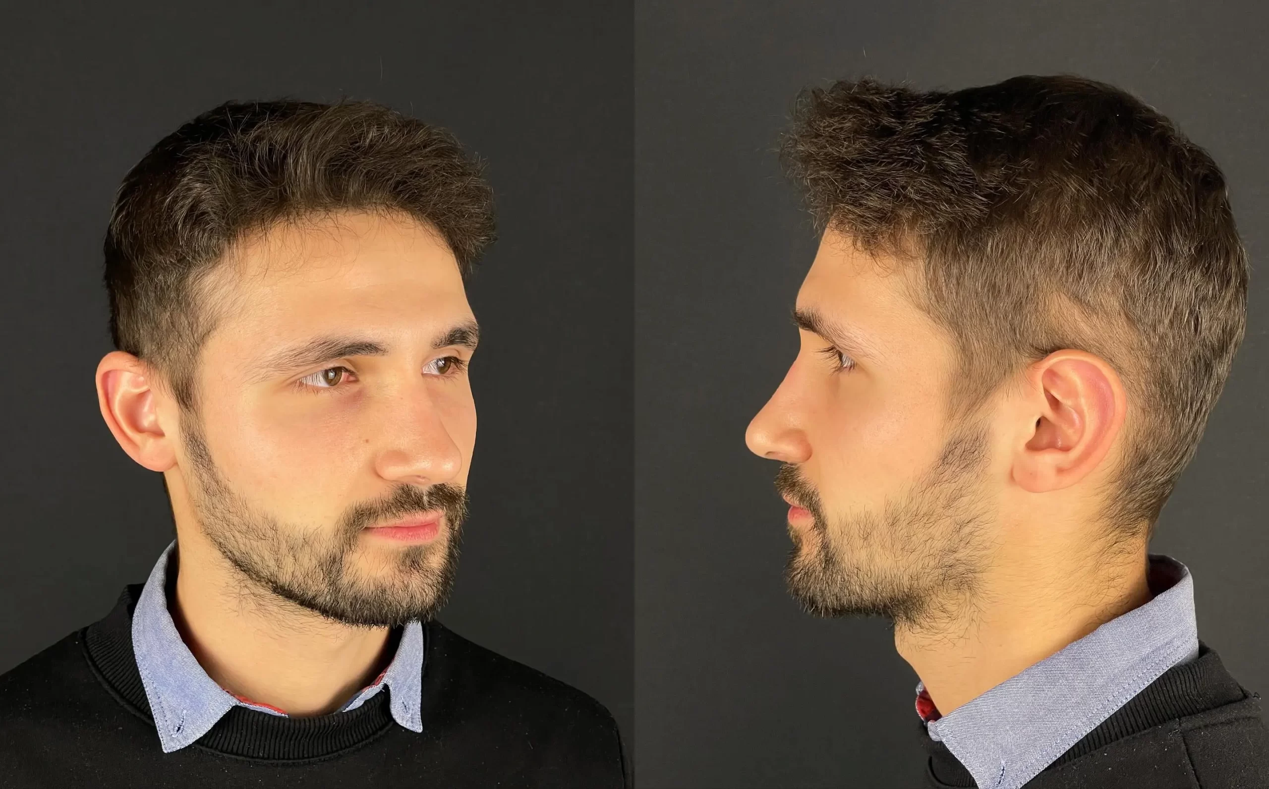 Rhinoplasty patient showing refined masculine profile from different angles, highlighting natural yet defined results.