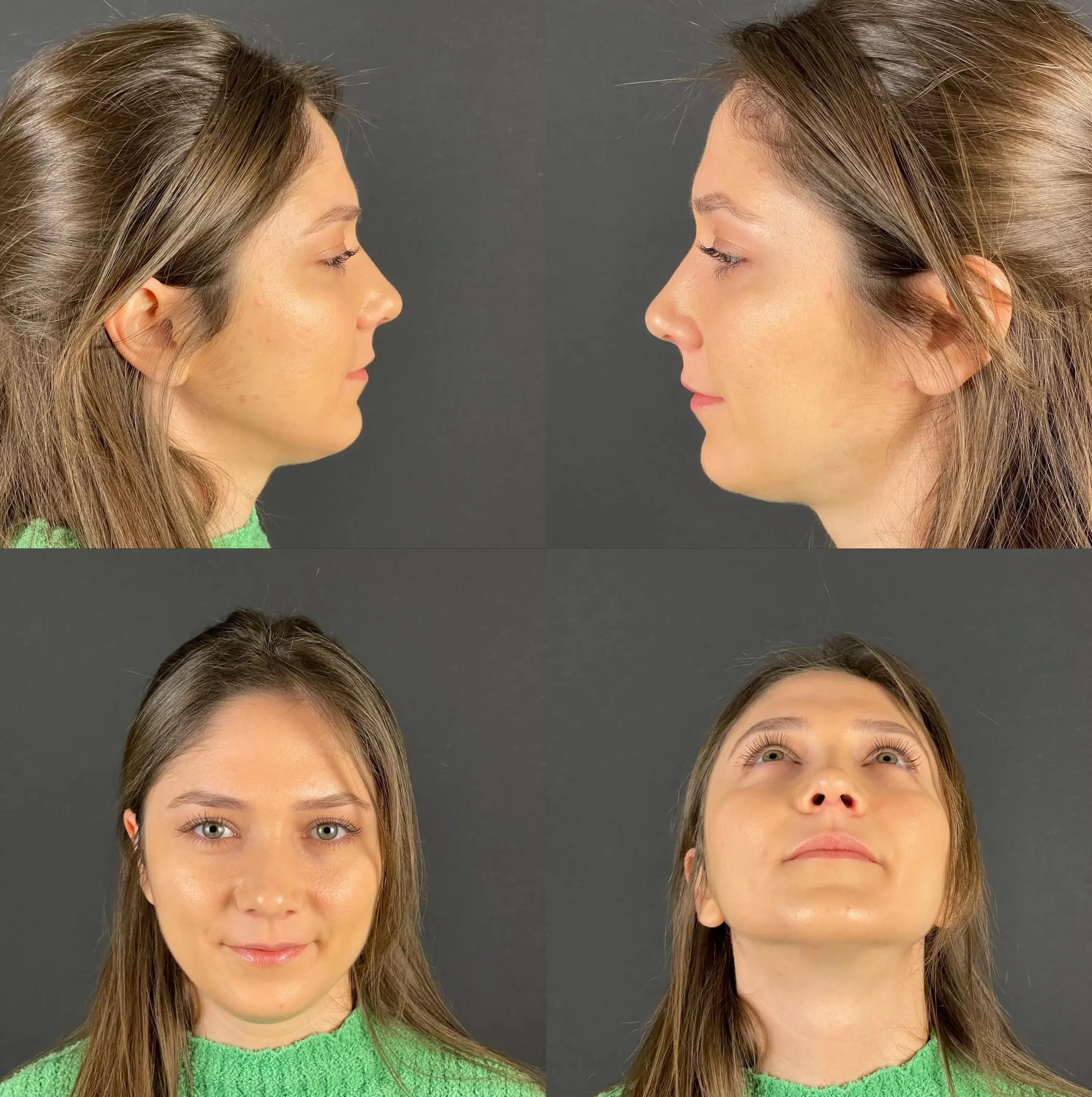 Post-rhinoplasty patient showing subtle and natural enhancements from profile, frontal, and under-view angles.