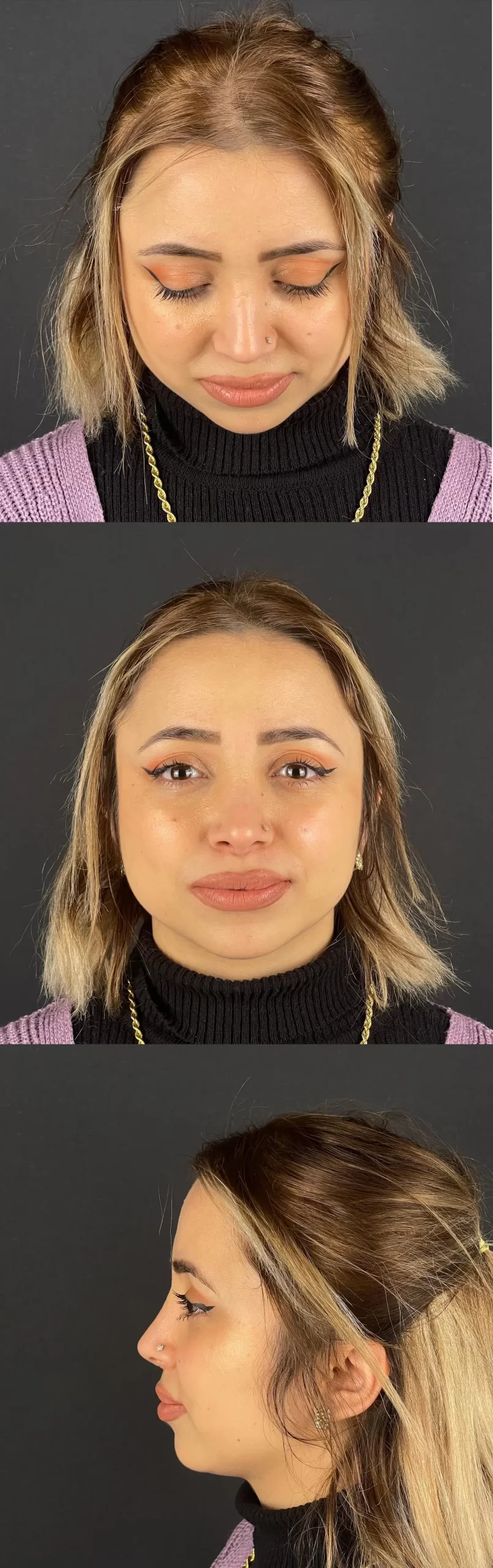 Rhinoplasty patient showing refined and balanced results from front, angled, and profile views.