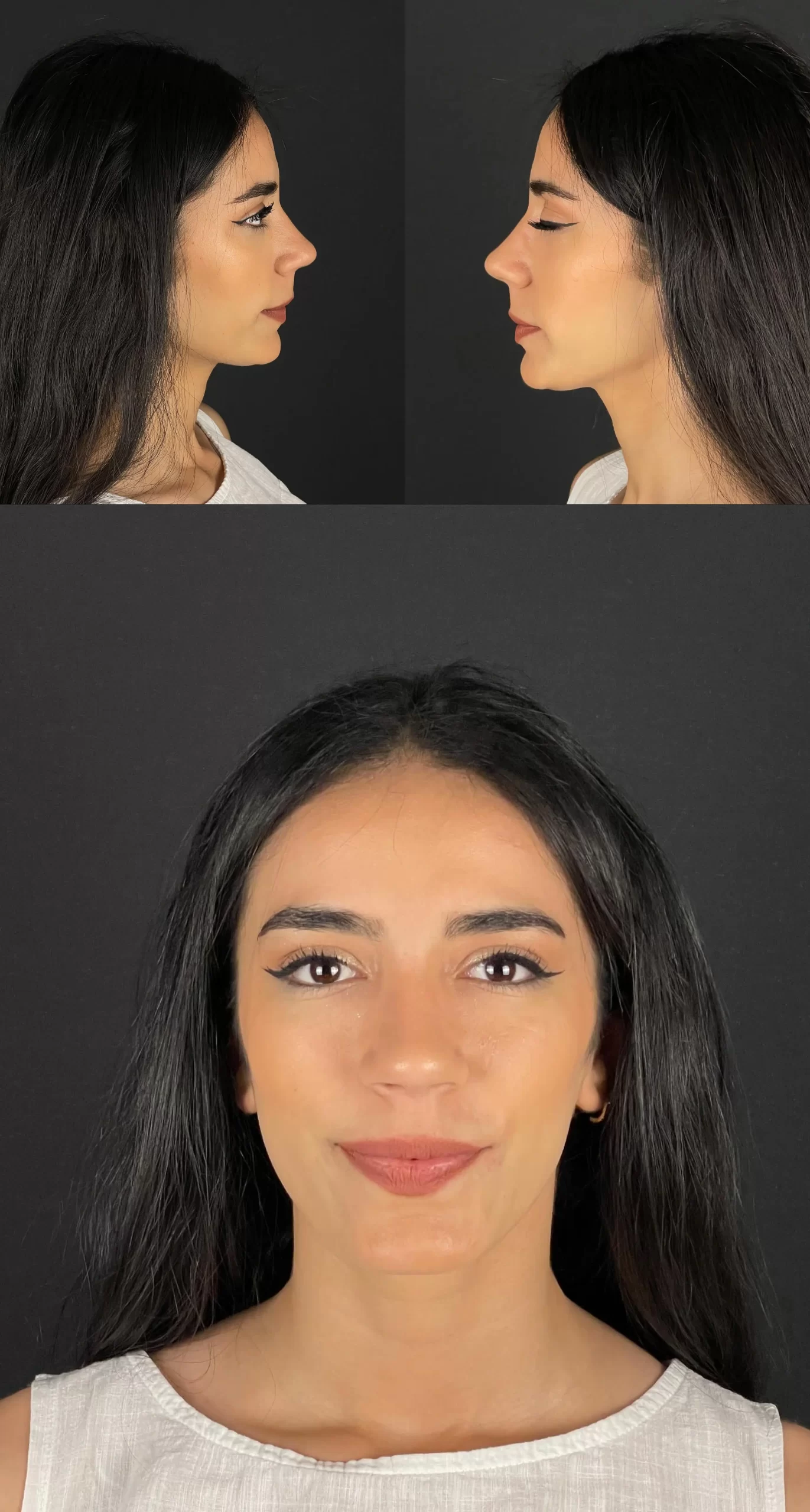 Rhinoplasty patient showing before and after views from profile and frontal angles, emphasizing natural and elegant results.