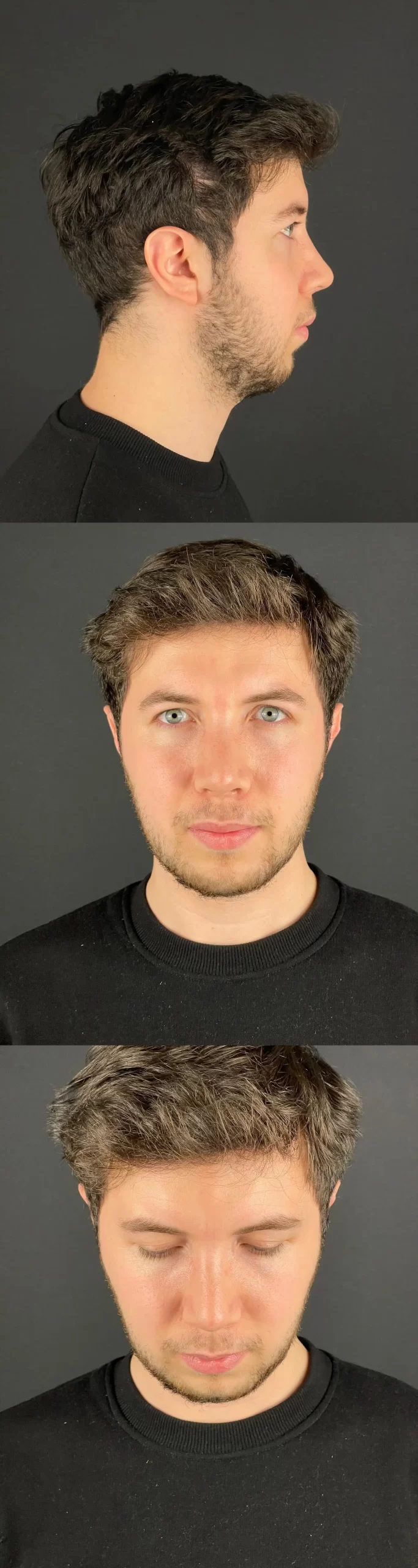 Rhinoplasty patient showing refined masculine profile from profile, frontal, and downward views, highlighting confident results.