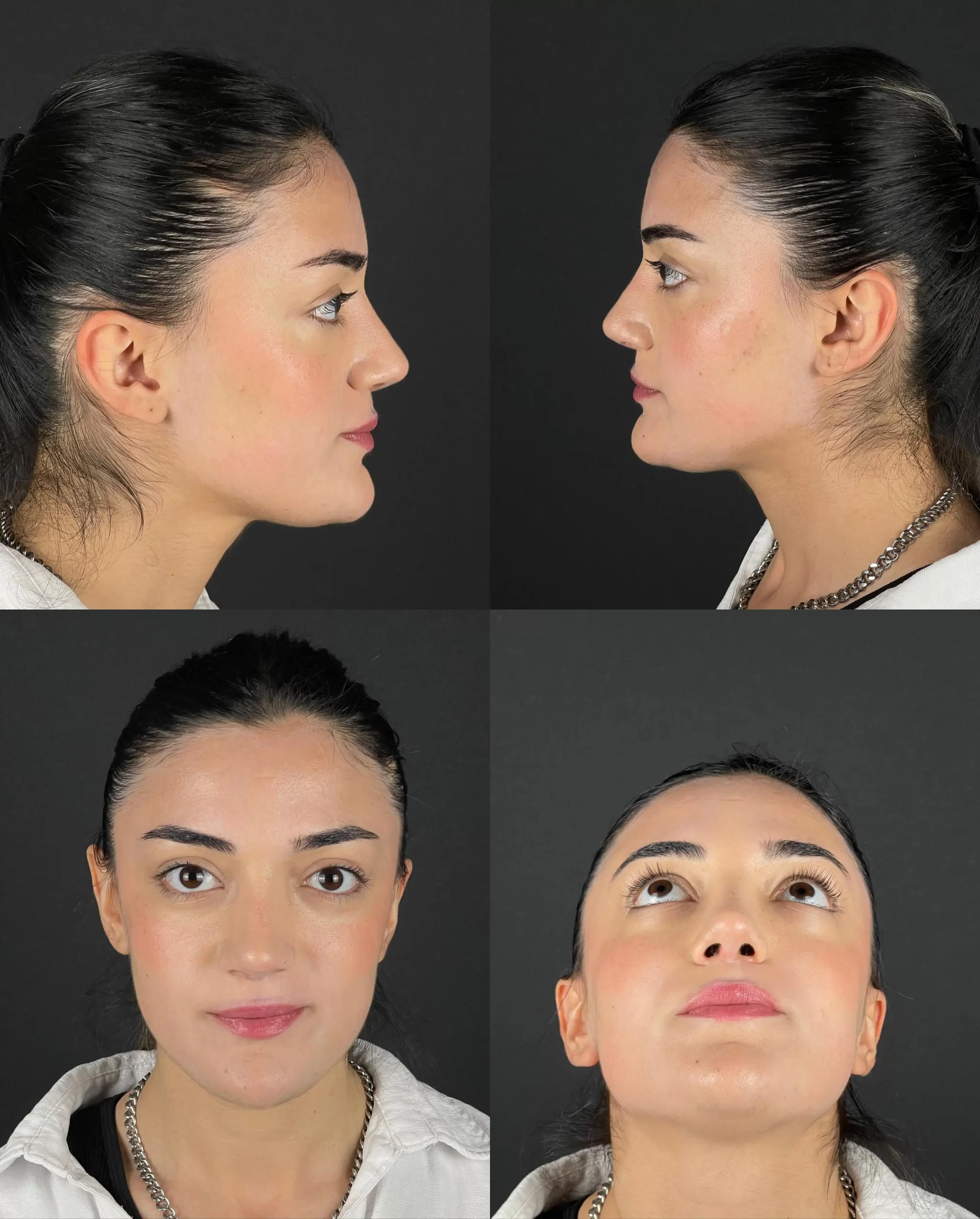 Post-rhinoplasty patient showing front, side, and under-view angles, demonstrating the balanced and refined results.