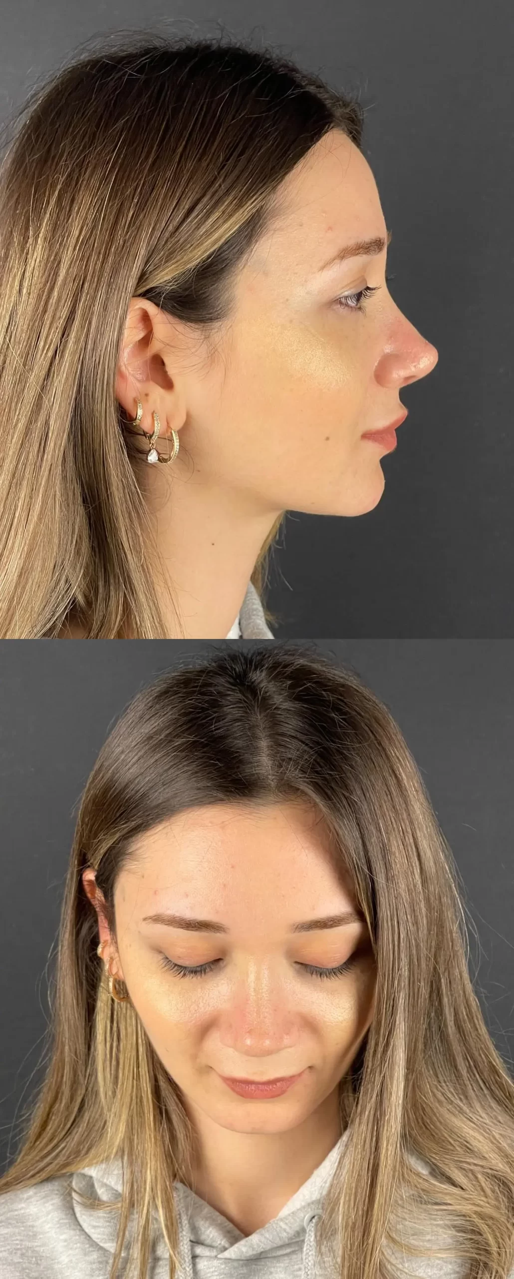 Rhinoplasty patient showing subtle refinements from side and angled views, highlighting natural beauty and balance.