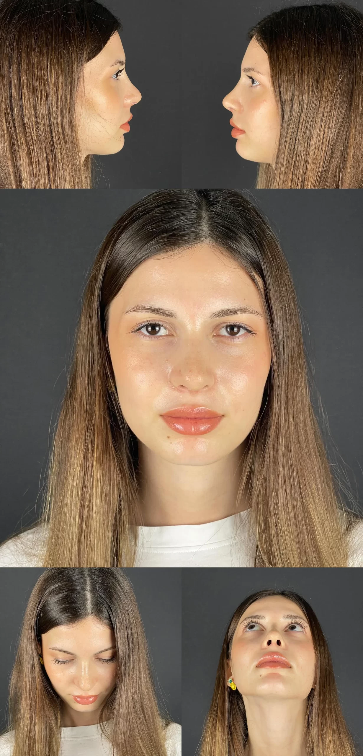 Post-rhinoplasty patient views from different angles: side, front, and bottom perspectives by Assoc. Prof. Dr. Nesrettin Fatih Turgut.