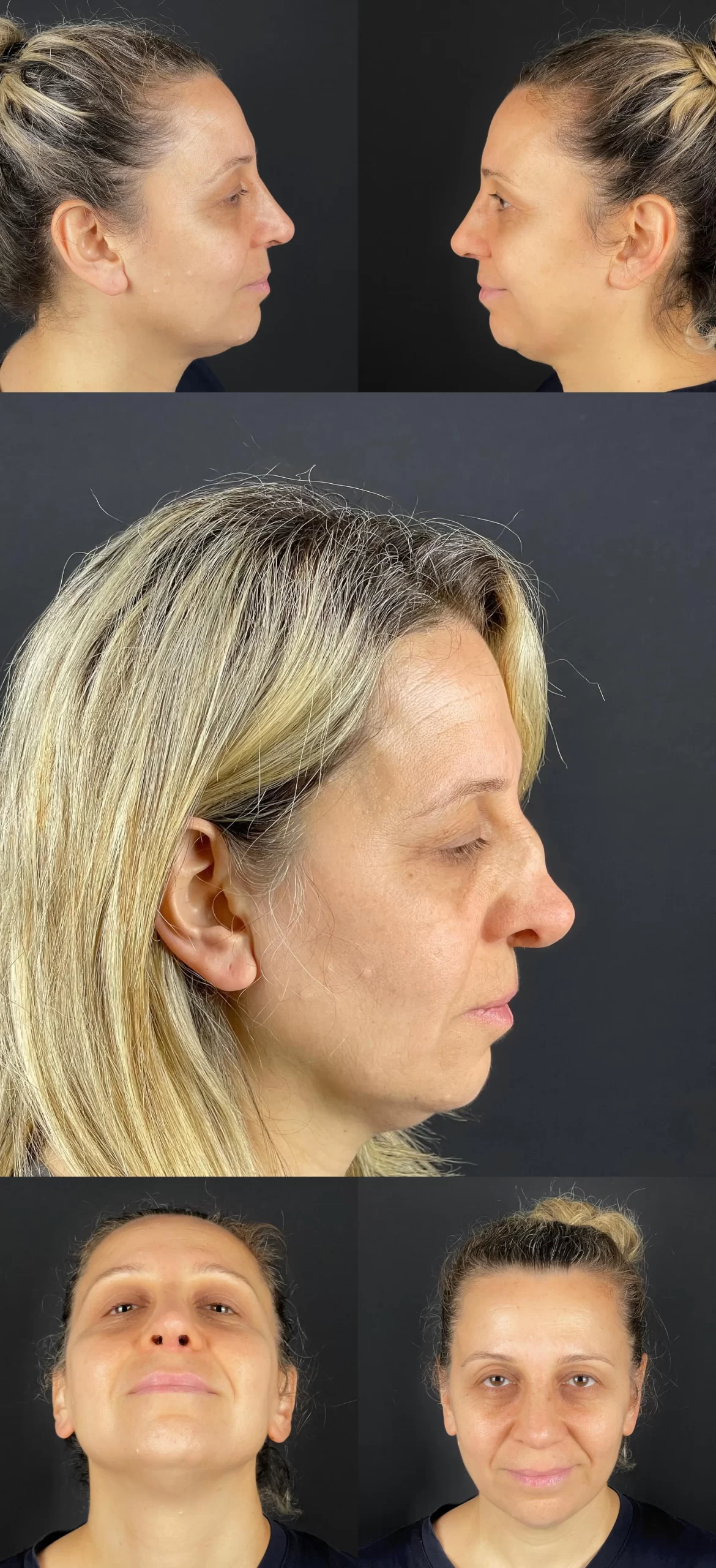Rhinoplasty transformation showing before and after views from different angles, emphasizing facial harmony.